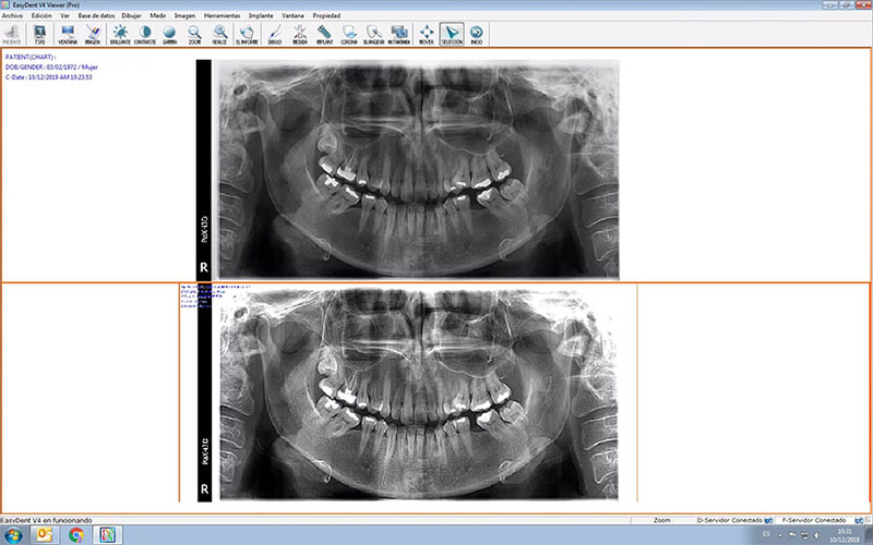 Comparación de la misma ortopantomografía con diferentes filtros y contrastes